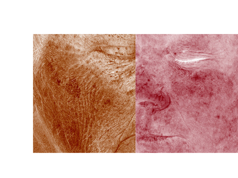 How Hyperpigmentation Is Measured