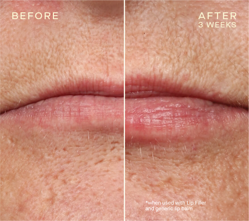 Lip Injection Las Vegas
